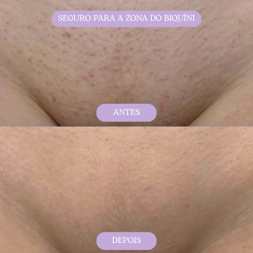 Goma depilatória ORYVIO SmoothTouch™ - Uma pele suave em segundos, sem lâminas, sem dor.