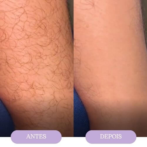 Goma depilatória ORYVIO SmoothTouch™ - Uma pele suave em segundos, sem lâminas, sem dor.