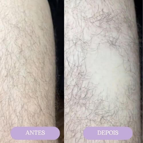 Goma depilatória ORYVIO SmoothTouch™ - Uma pele suave em segundos, sem lâminas, sem dor.